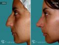 Cirugía de la nariz (Rinoplastia) - Paciente con nariz grande y Rinocifosis después de la rinoplastia vemos una nariz natural armónica al rostro a los 20 dias de postquirurgico