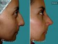 Cirugía de la nariz (Rinoplastia) - Paciente con nariz grande y Rinocifosis después de la rinoplastia vemos una nariz natural armónica al rostro a los 20 dias de postquirurgico