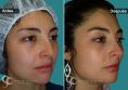 Cirugía de la nariz (Rinoplastia) - Paciente con Rinocifosis después de la rinoplastia vemos una nariz natural Sin imagen de Nariz operada