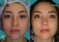 Cirugía de la nariz (Rinoplastia) - Paciente con Rinocifosis después de la rinoplastia vemos una nariz natural Sin imagen de Nariz operada