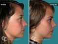 Cirugía de la nariz (Rinoplastia) - Paciente con nariz grande y Rinocifosis después de la rinoplastia vemos una nariz natural armónica mejorando el perfil