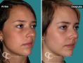 Cirugía de la nariz (Rinoplastia) - Paciente con nariz grande y Rinocifosis después de la rinoplastia vemos una nariz natural armónica mejorando el perfil