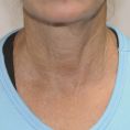 Exilis - Zdjęcie przed - Revival Clinic - Klinika Medycyny Estetycznej i Laseroterapii