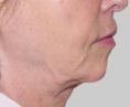 Exilis - Prezentowane zabiegi są zabegami z urzyciem urządzenia Exilis. Stystem działa na zasadzie termoliftingu tkanek oraz ultradzwięku. Pierwsze efekty zabiegowe uzyskujemy po 1,5 miesiąca od terapi zabiegowej. Zabiegi są lanczowe, szybki bezpieczne dla skóry. Przez cały rok możemy wykonywać tego typu zabiegi. System Exilis możemy stosować na ca le ciało a dostępne są dwie głowice o dużym mocach.
Zapraszamy Revival Clinic Warszawa