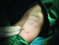 Leczenie nadpotliwości (hiperhydroza) - Prezentowane zdjęcia obrazują laserowe leczenie nadpotliwości. Efekt utrzymuje się ok 1,5 roku.