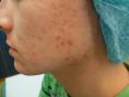 Laserová léčba akné - fotka před - Esthé Laser Clinic
