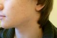 Laserová léčba akné - fotka před - Esthé Laser Clinic