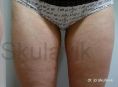 Liposukce - fotka před - Dr. med. Jozefina Skulavik