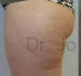 Liposukce - fotka před - Dr. med. Jozefina Skulavik