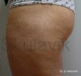 Liposukce - fotka před - Dr. med. Jozefina Skulavik
