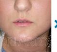 Lip augmentation - cheiloplasty - Photo before - Dr. med. Dagmar Arco