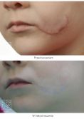 Laserowe usuwanie blizn - Zdjęcie przed - Bieńkowscy Clinic®