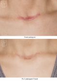 Laserowe usuwanie blizn - Zdjęcie przed - Bieńkowscy Clinic®