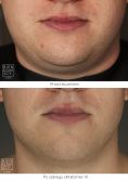 Nieinwazyjny lifting - Zdjęcie przed - Bieńkowscy Clinic®
