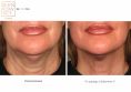Nieinwazyjny lifting - Zdjęcie przed - Bieńkowscy Clinic®