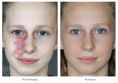 Leczenie naczyniaków (haemangioma) - Zdjęcie przed - Bieńkowscy Clinic®
