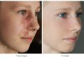 Leczenie naczyniaków (haemangioma) - Zdjęcie przed - Bieńkowscy Clinic®