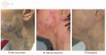 Leczenie naczyniaków (haemangioma) - Zdjęcie przed - Bieńkowscy Clinic®