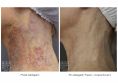 Leczenie naczyniaków (haemangioma) - Zdjęcie przed - Bieńkowscy Clinic®