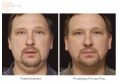 Liposukcja laserowa - Zdjęcie przed - Bieńkowscy Clinic®