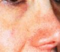 Spider veins laser removal (redness, birh marks) - Photo before - Klinika Laser Esthetic