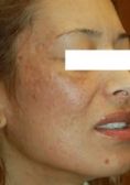 Terapia fotodinamica - Foto del prima - Dr. Luigi Mazzi