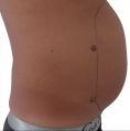Liposuction - Photo before - MUDr. Jozef Fedeleš PhD.