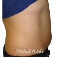 Liposuction - Photo before - MUDr. Jozef Fedeleš PhD.