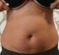 Liposuction - Photo before - MUDr. Jozef Fedeleš PhD.