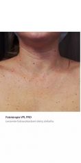 Fotoodmładzanie / odmładzanie skóry - Zdjęcie przed - Bieńkowscy Clinic®