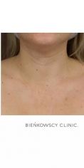 Fotoodmładzanie / odmładzanie skóry - Zdjęcie przed - Bieńkowscy Clinic®