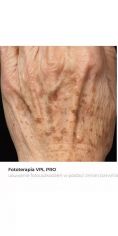 Fotoodmładzanie / odmładzanie skóry - Zdjęcie przed - Bieńkowscy Clinic®