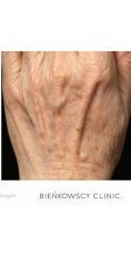 Fotoodmładzanie / odmładzanie skóry - Zdjęcie przed - Bieńkowscy Clinic®