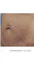Usuwanie rozstępów - Zdjęcie przed - Bieńkowscy Clinic®