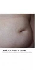 Usuwanie rozstępów - Zdjęcie przed - Bieńkowscy Clinic®