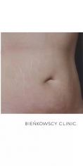 Usuwanie rozstępów - Zdjęcie przed - Bieńkowscy Clinic®