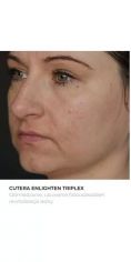 Fotoodmładzanie / odmładzanie skóry - Zdjęcie przed - Bieńkowscy Clinic®