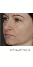 Fotoodmładzanie / odmładzanie skóry - Zdjęcie przed - Bieńkowscy Clinic®