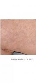 Leczenie żylaków - Zdjęcie przed - Bieńkowscy Clinic®