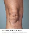 Liposukcja (odsysanie tłuszczu) - Zdjęcie przed - Bieńkowscy Clinic®