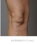 Liposukcja (odsysanie tłuszczu) - Zdjęcie przed - Bieńkowscy Clinic®