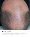 Przeszczep włosów - transplatacja włosów - Zdjęcie przed - Bieńkowscy Clinic®