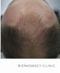 Przeszczep włosów - transplatacja włosów - Zdjęcie przed - Bieńkowscy Clinic®