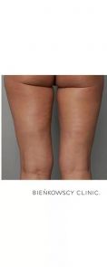Liposukcja (odsysanie tłuszczu) - Zdjęcie przed - Bieńkowscy Clinic®
