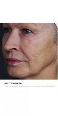 Lipofiling - przeszczep tłuszczu - Zdjęcie przed - Bieńkowscy Clinic®