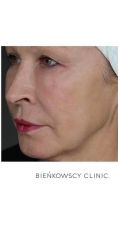 Lipofiling - przeszczep tłuszczu - Zdjęcie przed - Bieńkowscy Clinic®