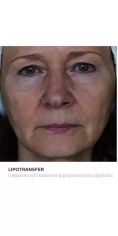 Lipofiling - przeszczep tłuszczu - Zdjęcie przed - Bieńkowscy Clinic®