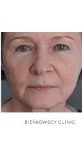 Lipofiling - przeszczep tłuszczu - Zdjęcie przed - Bieńkowscy Clinic®