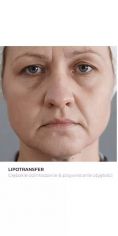 Lipofiling - przeszczep tłuszczu - Zdjęcie przed - Bieńkowscy Clinic®