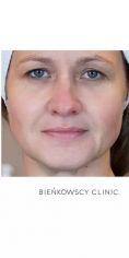 Lipofiling - przeszczep tłuszczu - Zdjęcie przed - Bieńkowscy Clinic®